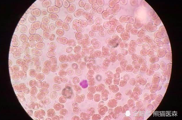 尿常规出现红细胞,别紧张,可能是假象