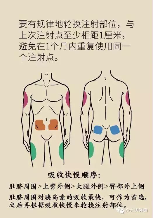 肝素打大腿的位置图图片