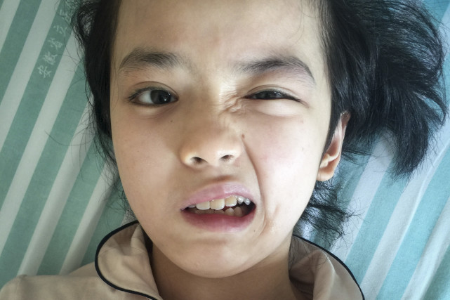 安徽11岁漂亮女孩医院icu里逃过一劫今口眼歪斜解说梦破碎