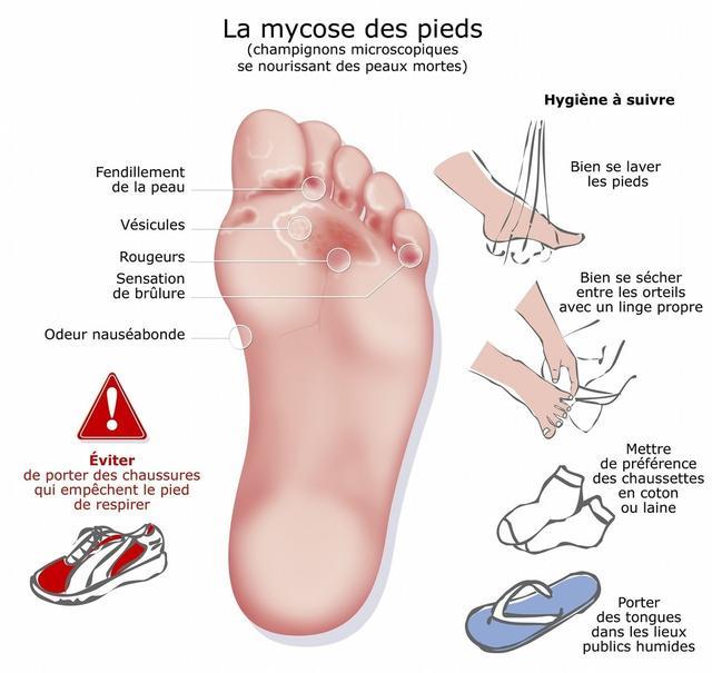 糖尿病人 为何要做眼底检查 要警惕足部的早期征兆 有什么后果 腾讯新闻