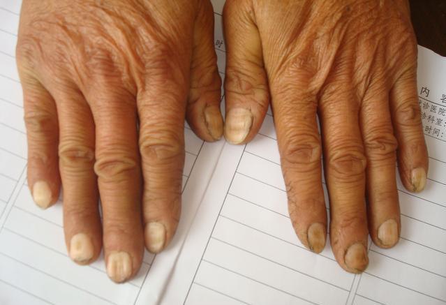 心脏不好指甲会有4个异常手指还有3个表现养好心脏才安康