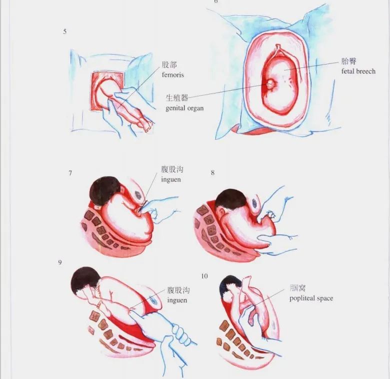 圖解婦產科小手術23:產婦臀位牽引手術