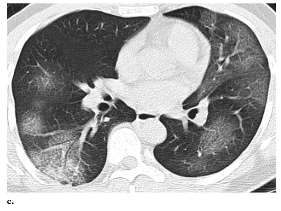 新冠肺部阴影图片