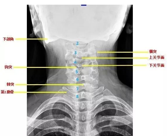 頸椎病x線診斷