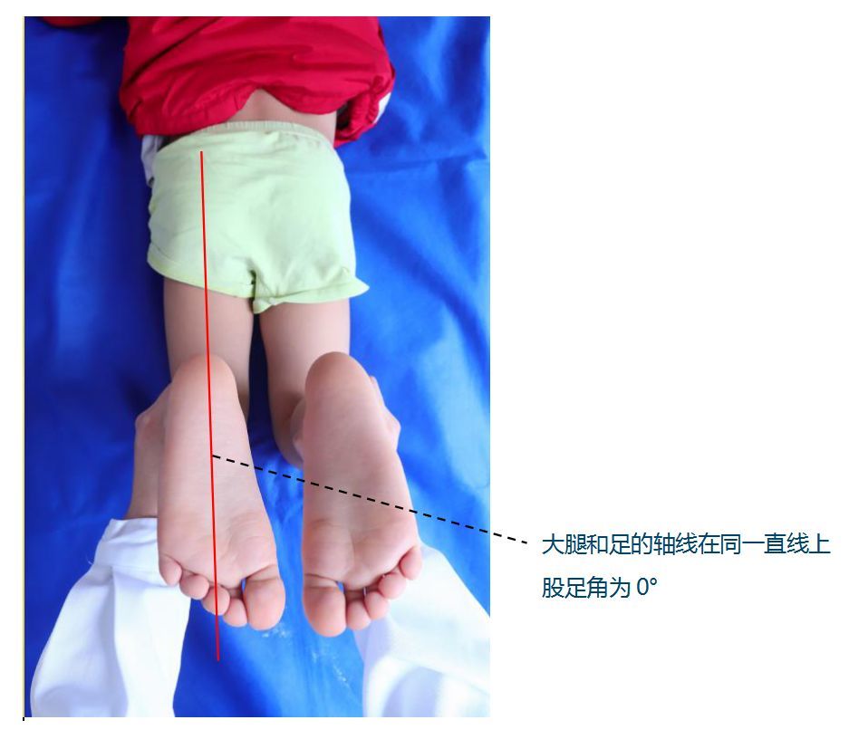 小孩外八字腿(小孩外八字腿型怎么矫正)