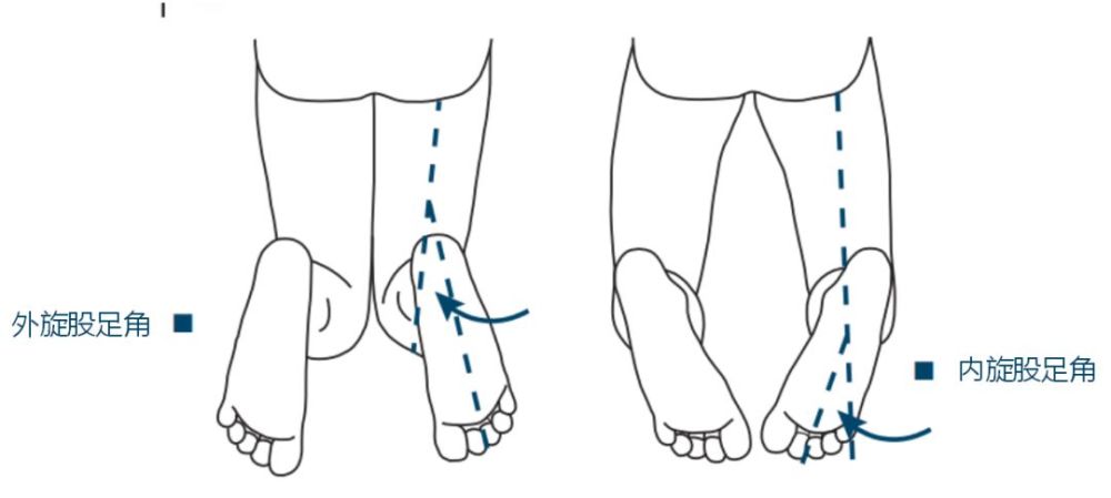 孩子走路內八字外八字長大以後會影響工作和生活嗎