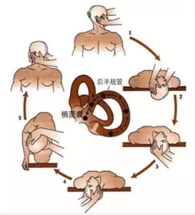 手法复位示意医院开展大量耳石症手法复位技术,取得良好疗效眩晕天旋