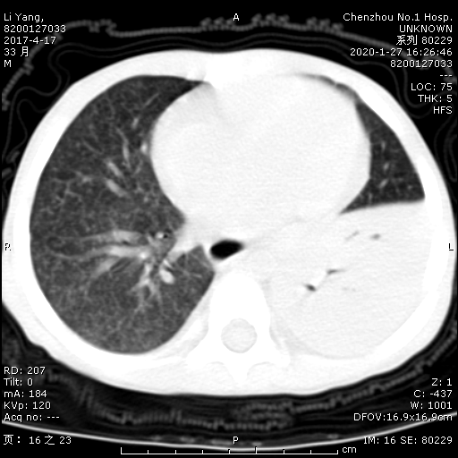 胸部ct提示左下肺大片实变