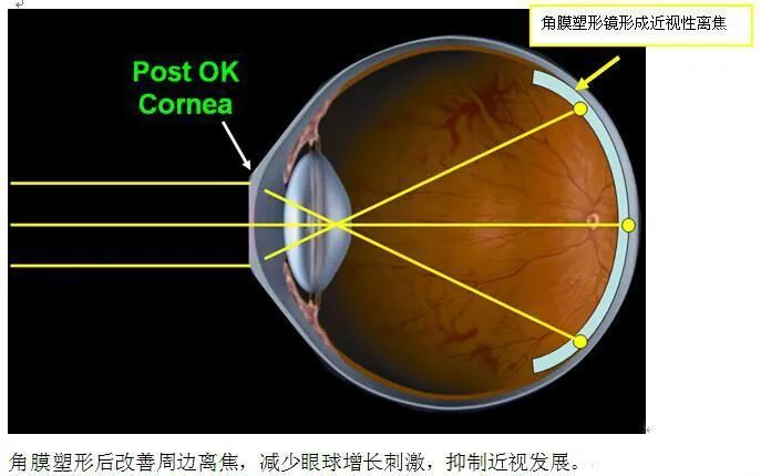 號稱不吃藥不手術治癒近視你信嗎