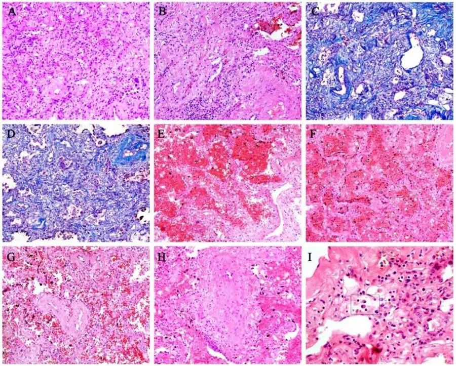 新冠肺炎sarsmers都有怎样的病理特征
