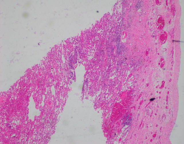 18岁双肺多发肺大疱最后的病因竟是