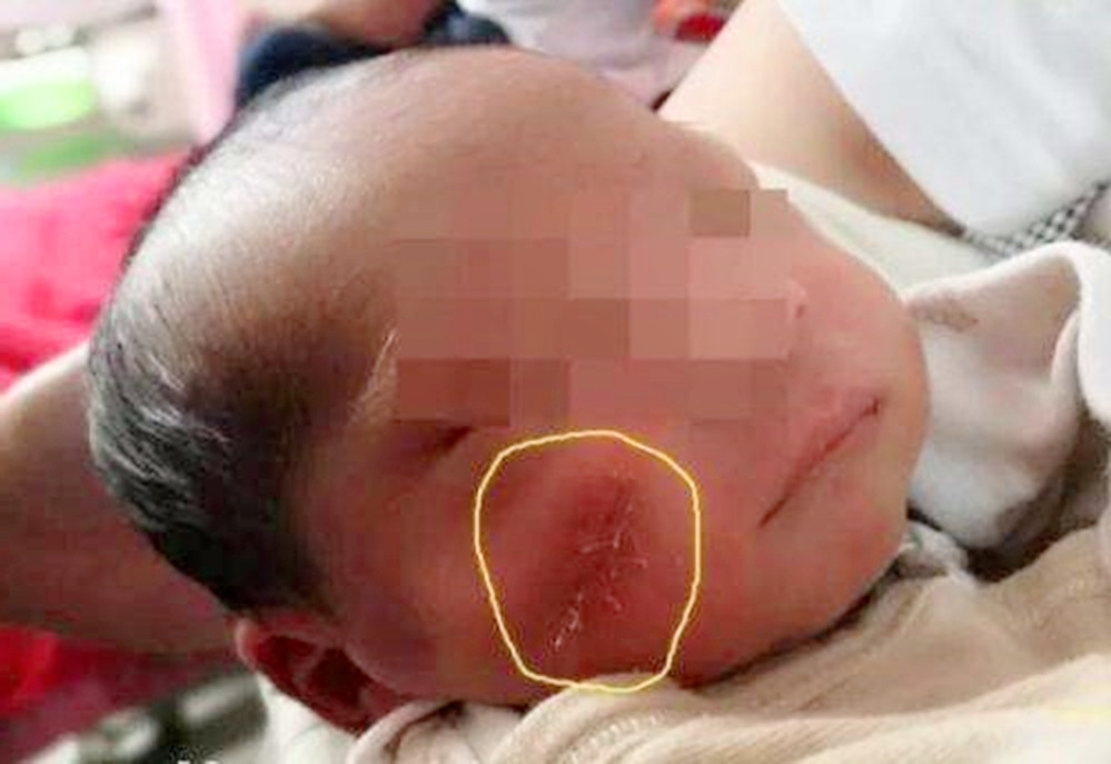 4年前因吃奶太用力,被亲生妈妈用剪刀划伤脸的男婴,如今怎样?