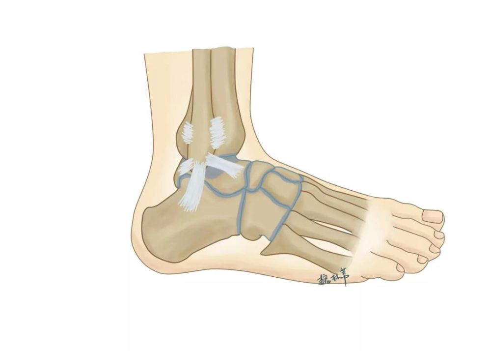 陈旧性的跟腱断裂怎么办?手术修复后容易出现什么并发症?
