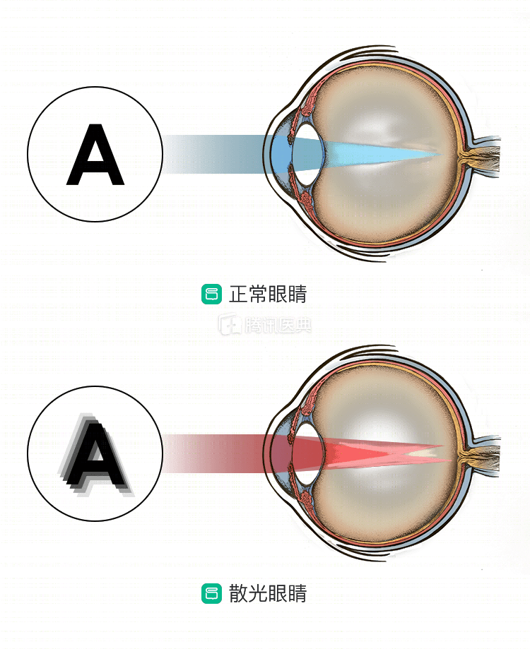 眼痛流泪眯眼家长千万别大意预防儿童散光要牢记这5点很关键