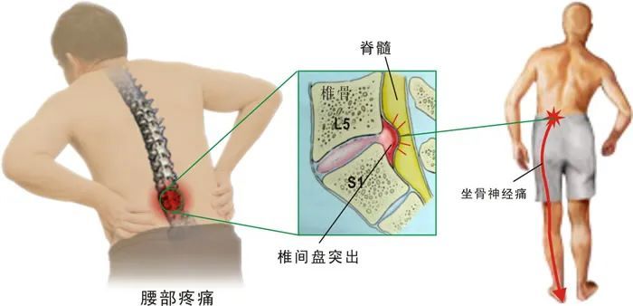 坐骨神经痛 到底是梨状肌综合征还是腰椎间盘突出呢 辨别与治疗一文搞定 腾讯新闻