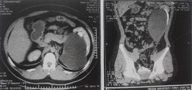 这是一个左肾的重复肾畸形合并左上肾积水.