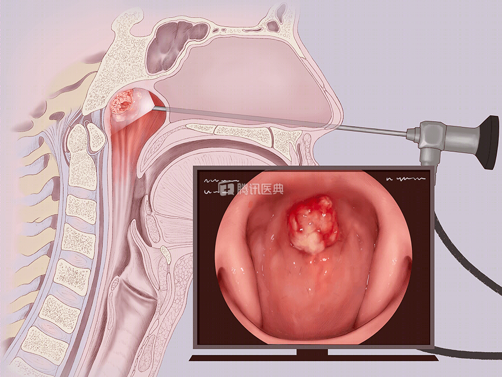 晚期鼻咽癌患者如何治疗专家给出了这样的答案可有效提高生存率快收藏