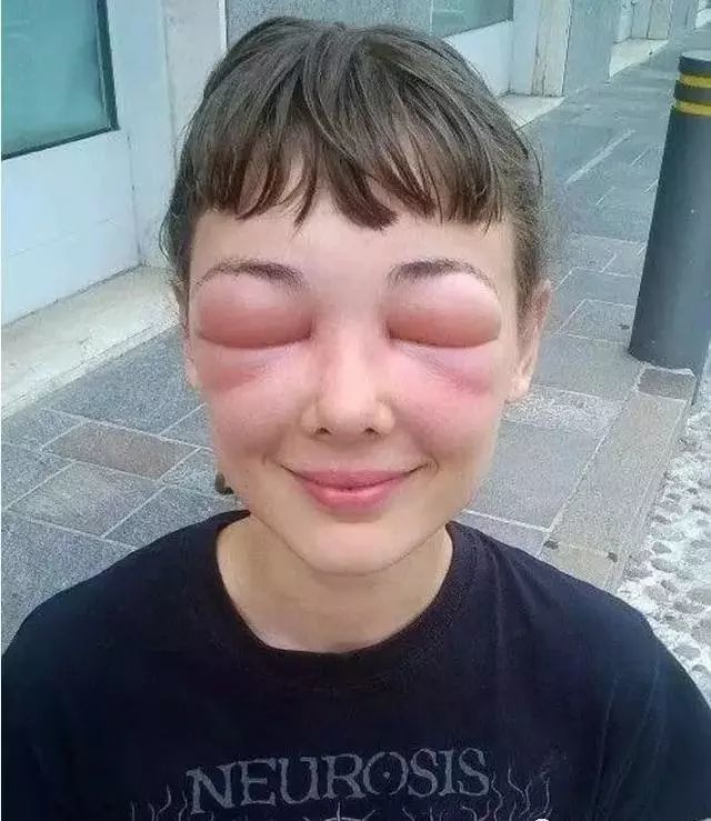 被蜜蜂叮了眼皮,肿得像外星人一样,但妹子依旧在笑,有点可爱.