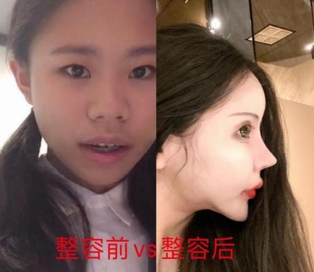 整容|13岁就开始整容的女网红出现后遗症！医生称嘴巴缝太多无法修复