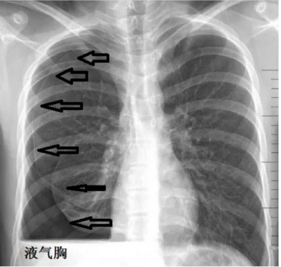 气胸的影像学表现在古代,气胸随时可能会要命,在科技发达的今天,很多