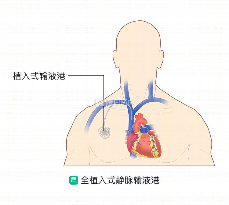 癌症化疗picc和输液港使用哪个更好专家为你解析它们的优点及禁忌症