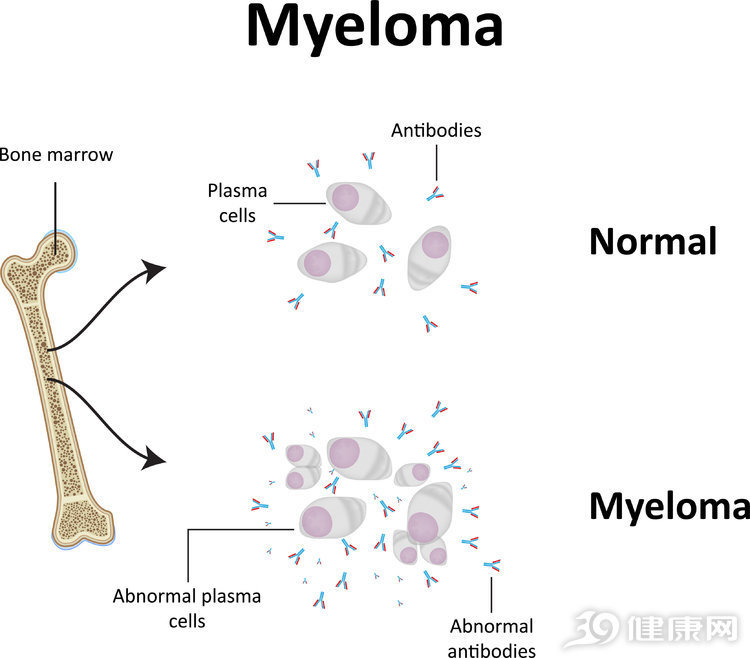 醫生提醒多發性骨髓瘤對老人威脅最大出現2類症狀要小心