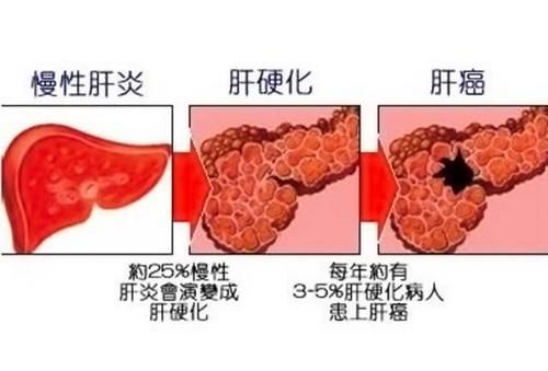 慢性肝炎   肝硬化   肝癌三步曲