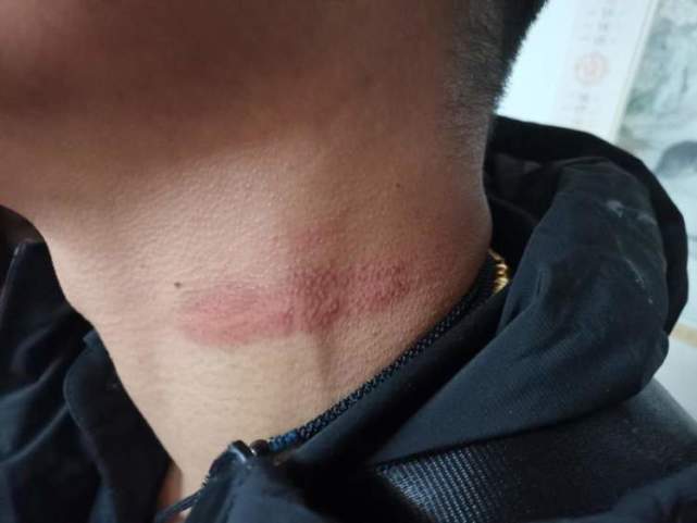 男子骑车时被悬空垂下的线缆勒住脖子掀翻在地