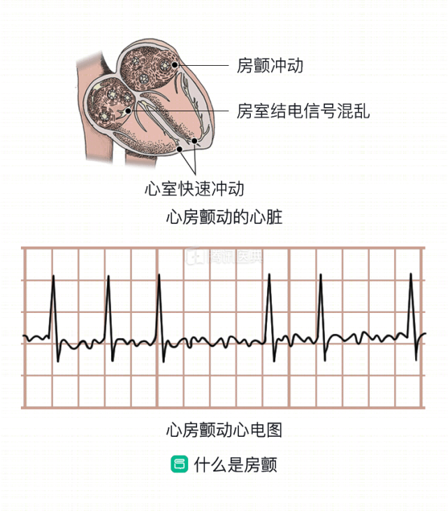 总心慌是得了房颤吗医生别慌先看看你是不是有这5种情况再判断