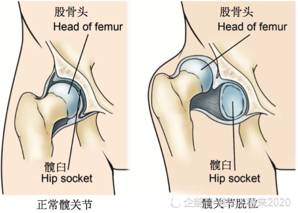 关节脱臼的紧急处理 腾讯新闻