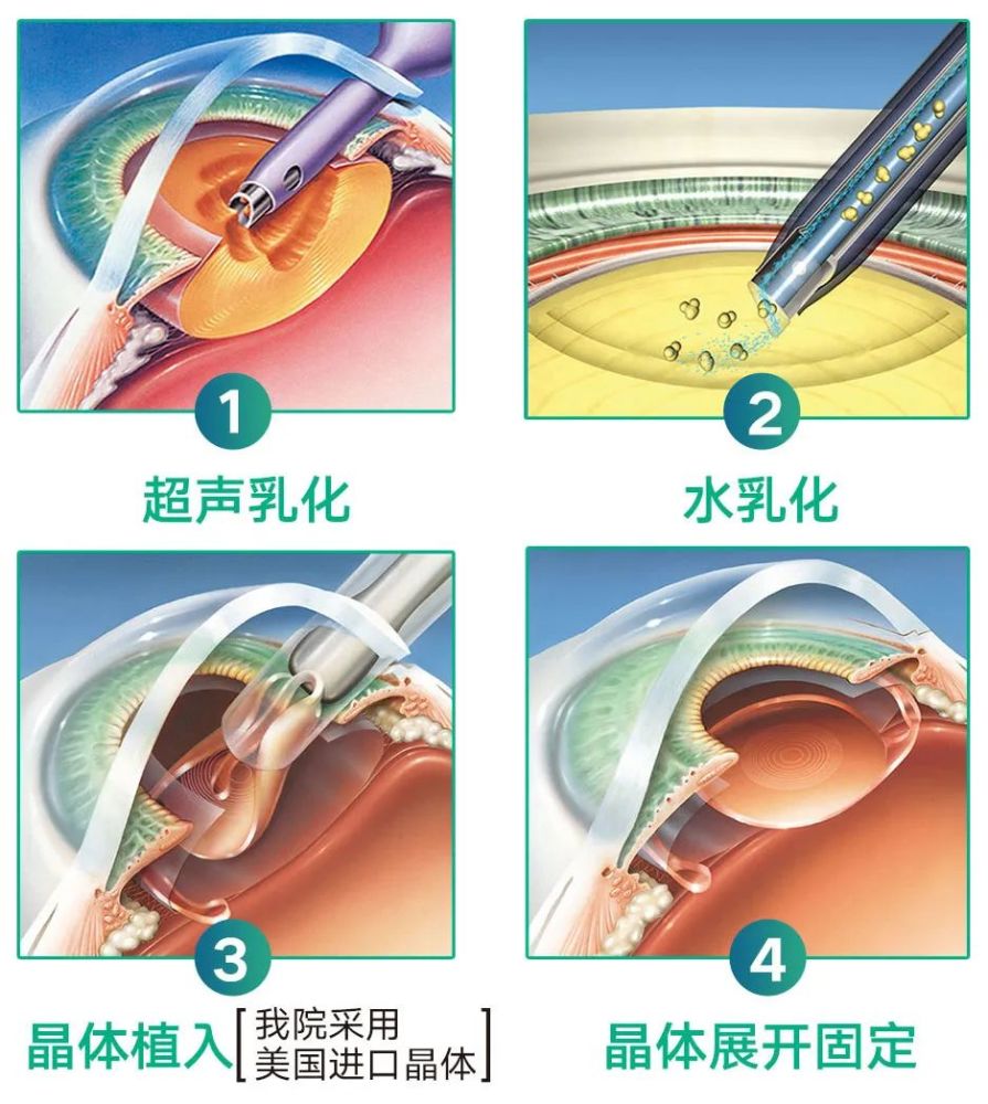 晶體植入的全過程我院聘請國內知名專家主持開展超聲乳化白內障手術