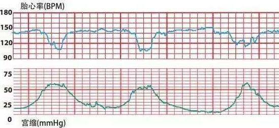 "胎心监护图"怎么看?