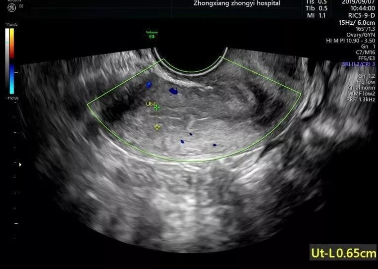 单角子宫超声图片图片