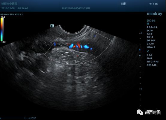 单角子宫超声图片图片
