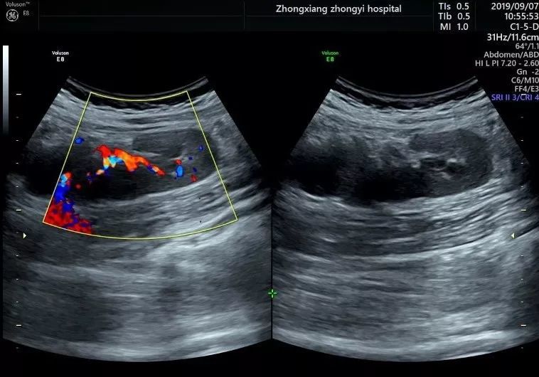 单角子宫超声图片图片