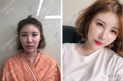 在韩国一般做全脸整容多少钱 万够吗 10万可以整成什么样 腾讯新闻