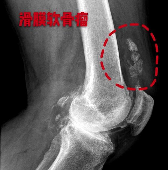 走路膝盖疼屈膝髌骨上方鼓个包像个鸡蛋这是啥情况