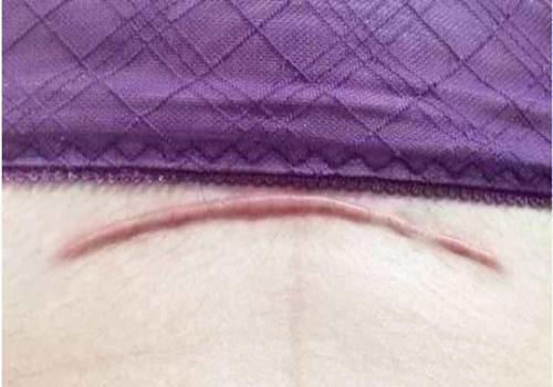 剖宫产后疤痕,为什么有的深,有的浅?不留痕的窍门有哪些?