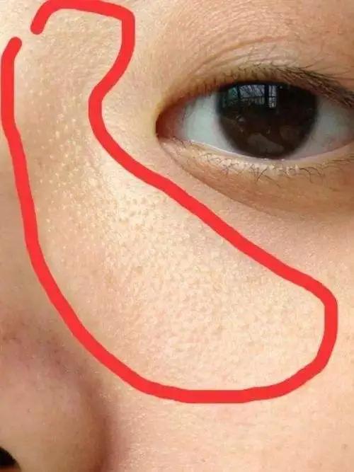 名门泽佳:眼部脂肪粒如何以形成的 教你几个有效的小妙招