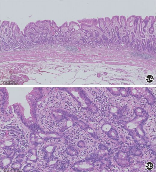 日本胃腺瘤及早期高分化腺癌的病理诊断_腾讯新闻