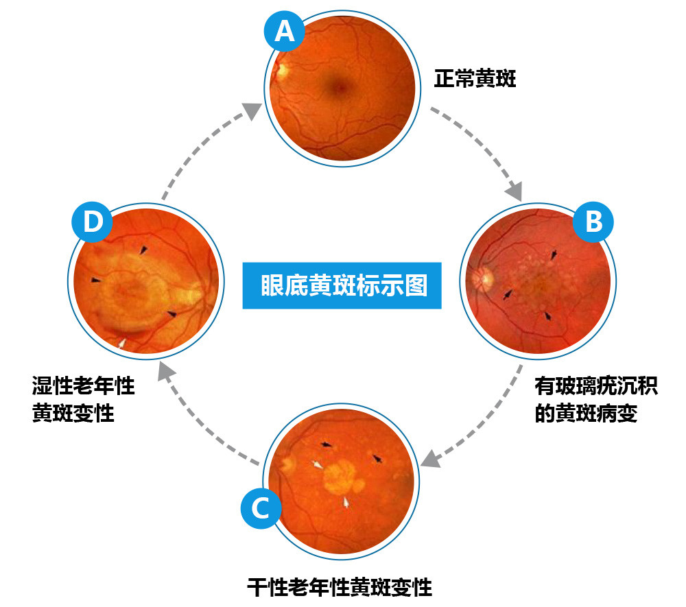 漳州眼底病專家:眼底出血≠眼睛充血,需及早治療,否則致盲!_騰訊新聞