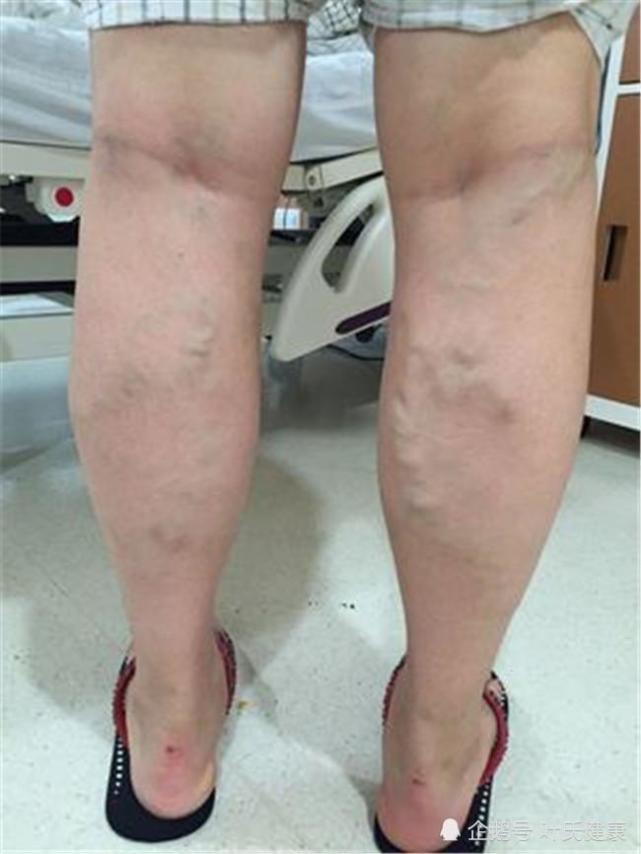 别小瞧静脉曲张后悔莫及3个小方法轻松预防整个人都神清气爽