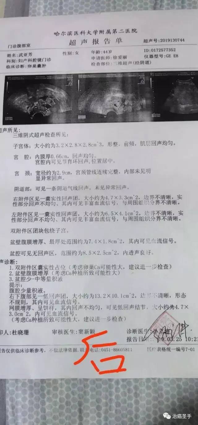 卵巢癌的中西医结合治愈经验 腾讯网