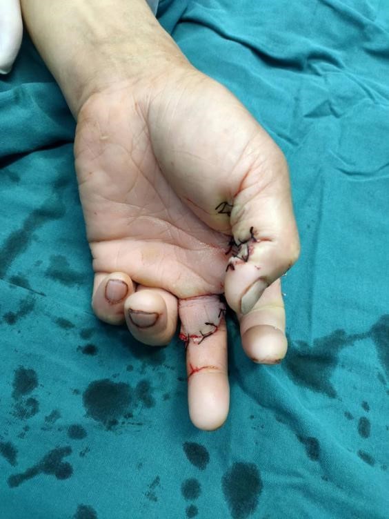 老师傅复工竟失手切下三根手指久休手生还需谨慎