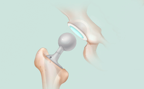 髋关节置换手术前,一定要做好这5点准备!