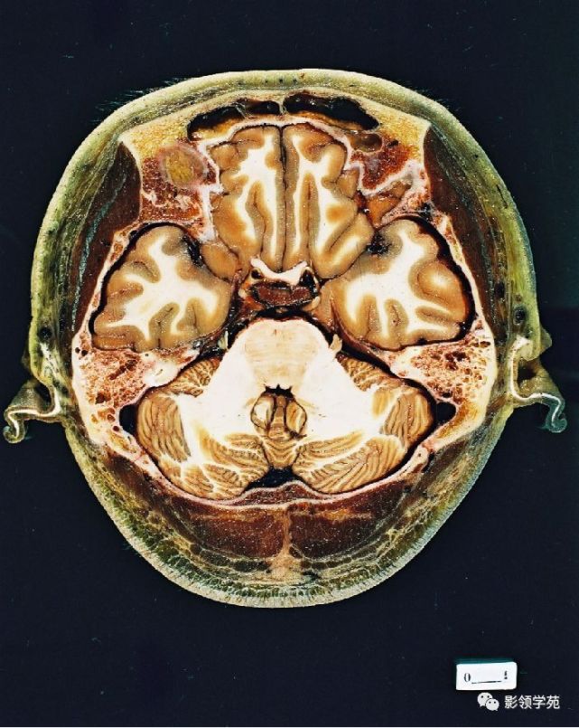 基底節區結構基底節(basal ganglia)(又稱基底神經節)是指從胚胎端腦