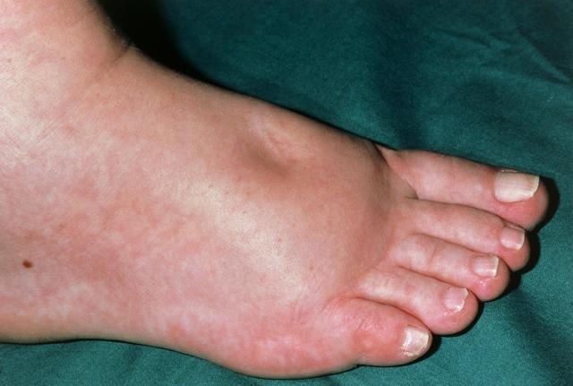 躲不掉的孕期水肿,两个方面双管齐下,孕妈妈轻松应对