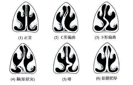 鼻中隔偏曲有什麼影響