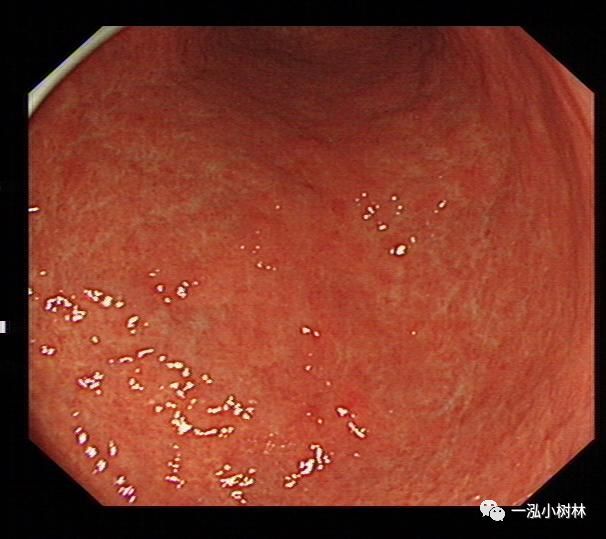 例2女性,60岁,慢性萎缩性胃炎伴肠上皮化生,hp 例3女性,40岁,萎缩性