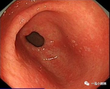慢性萎缩性胃炎胃镜图图片
